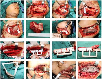 Application of 3D printed titanium mesh and digital guide plate in the repair of mandibular defects using double-layer folded fibula combined with simultaneous implantation